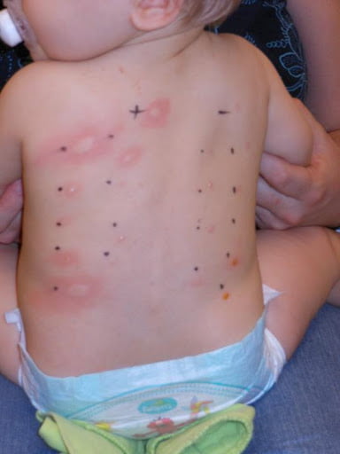 L'allergie à la fraise chez l'enfant : causes, symptomes et traitement