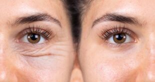 questions sur la blépharoplastie