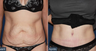 conseils recommandations abdominoplastie