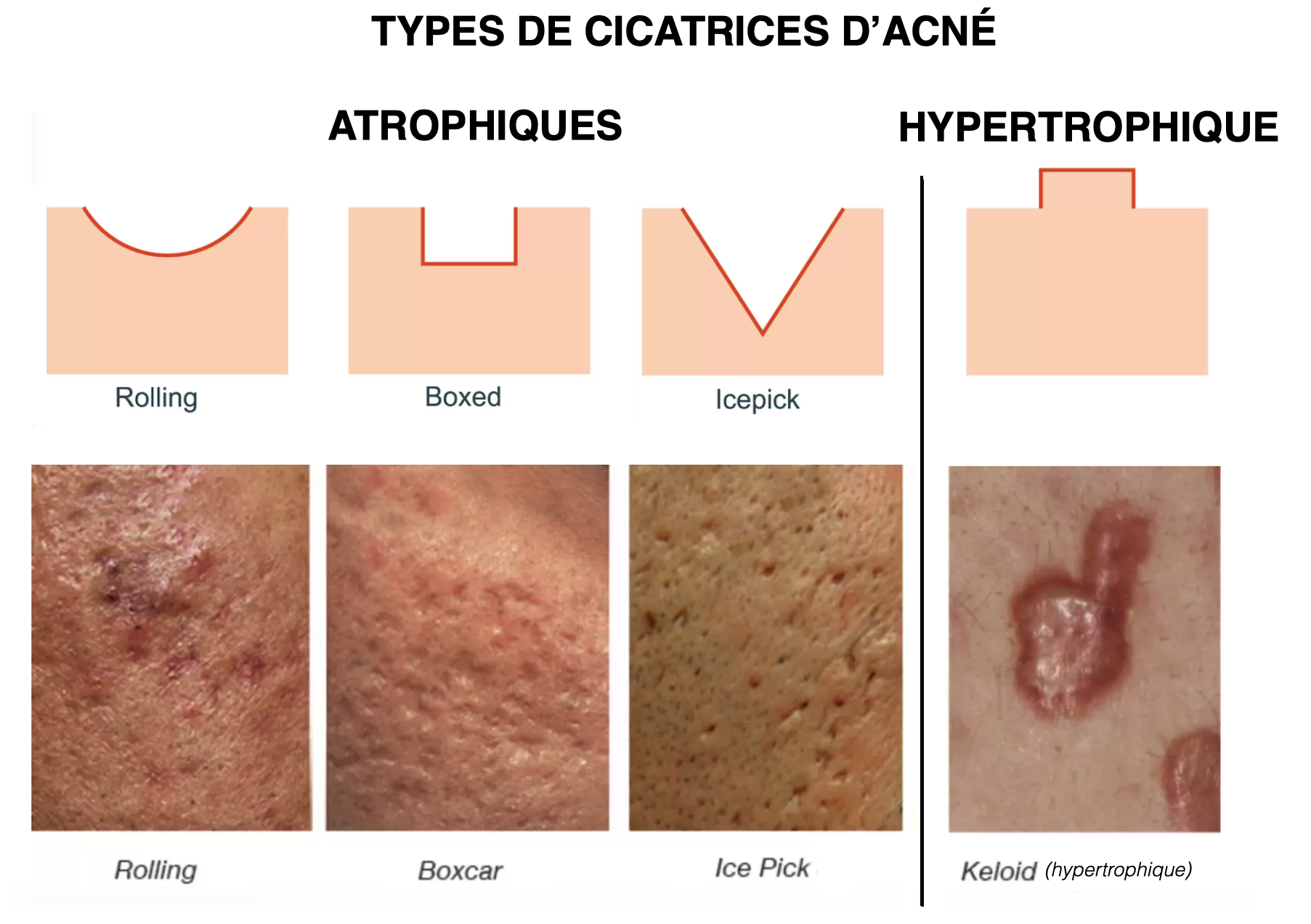 Types cicatrices : hypertrophiques, chéloïdes, atrophique et rétractile