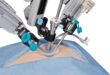 laparoscopie à port unique en chirurgie gynécologique