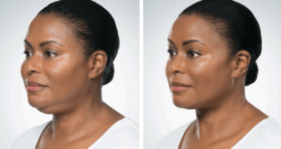 K comme Kybella : Injection pour réduire le double menton