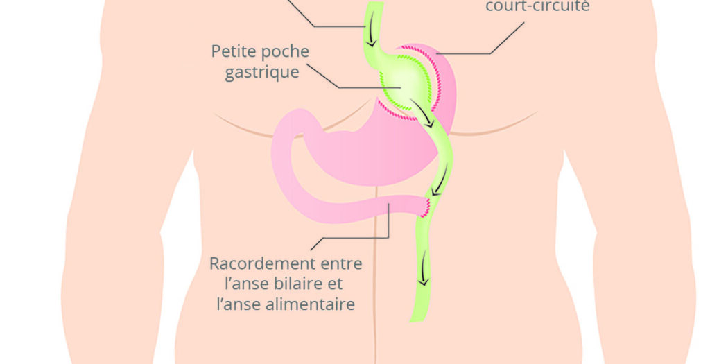 bypass gastrique