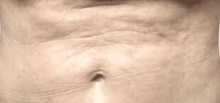 F comme Fibrose : Comprendre les mécanismes de réparation tissulaire