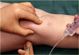 infiltrations articulaires